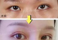 眼部整形,探索眼部整形手术的奥秘与技巧
