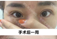 拉双眼皮整形医院哪里好,揭秘全国拉双眼皮整形医院哪家更胜一筹