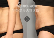 整形吸脂,揭秘吸脂技术，塑造健康美丽人生