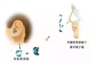 自体软骨隆鼻手术整形,自然和谐之美，重塑挺翘美鼻之旅