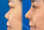做鼻子整形,焕发自信之美——鼻子整形全解析